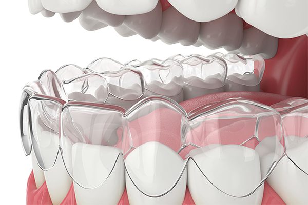 Invisalign-1