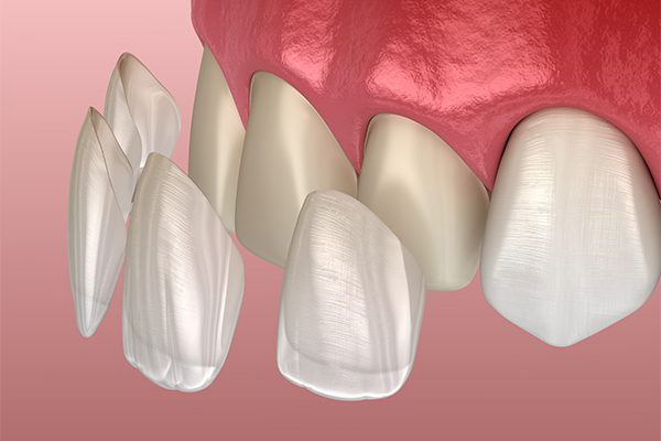 c.veneers1