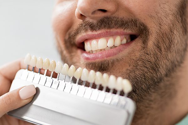 veneers-2